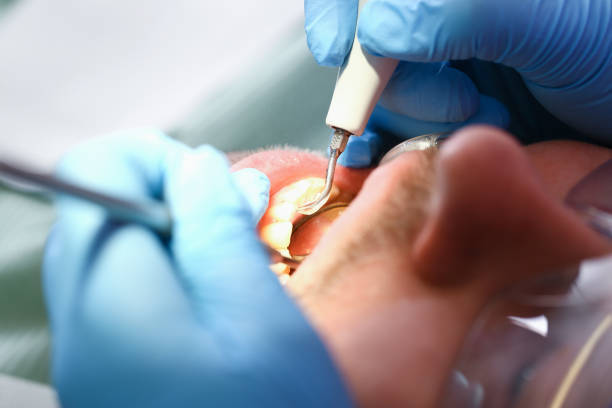Best Knocked-Out Tooth (Avulsed Tooth) Treatment in Becker, MN